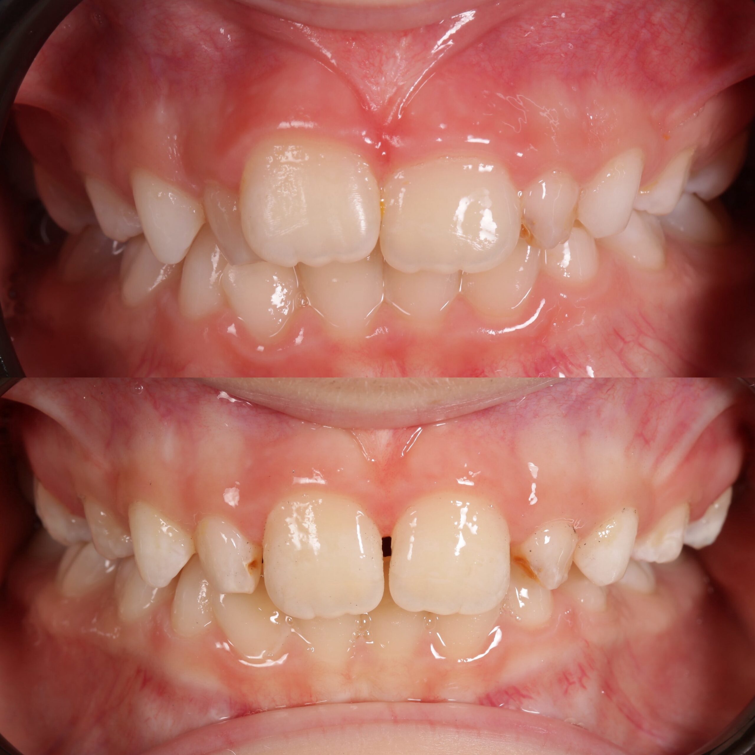 ортодонтія для дітей