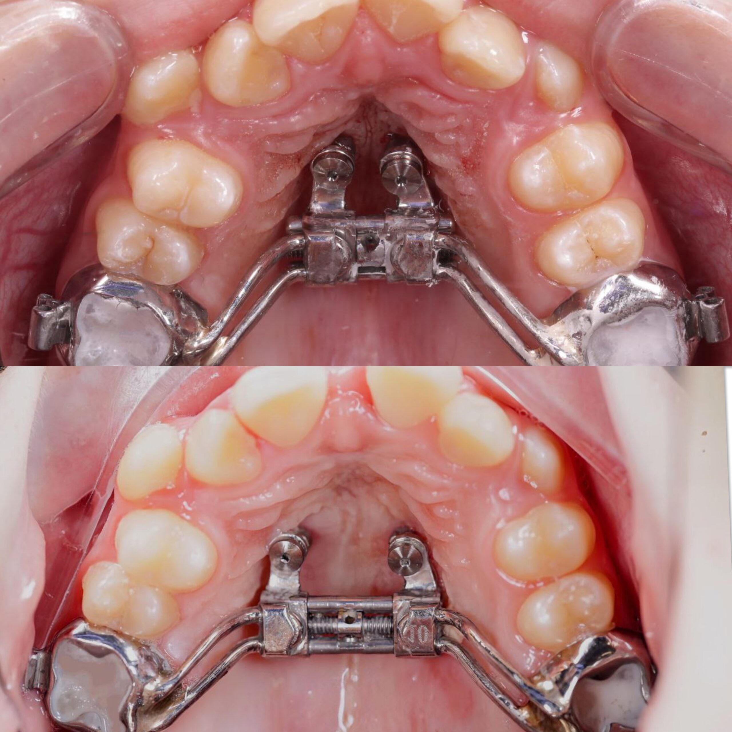 порушення прикусу
