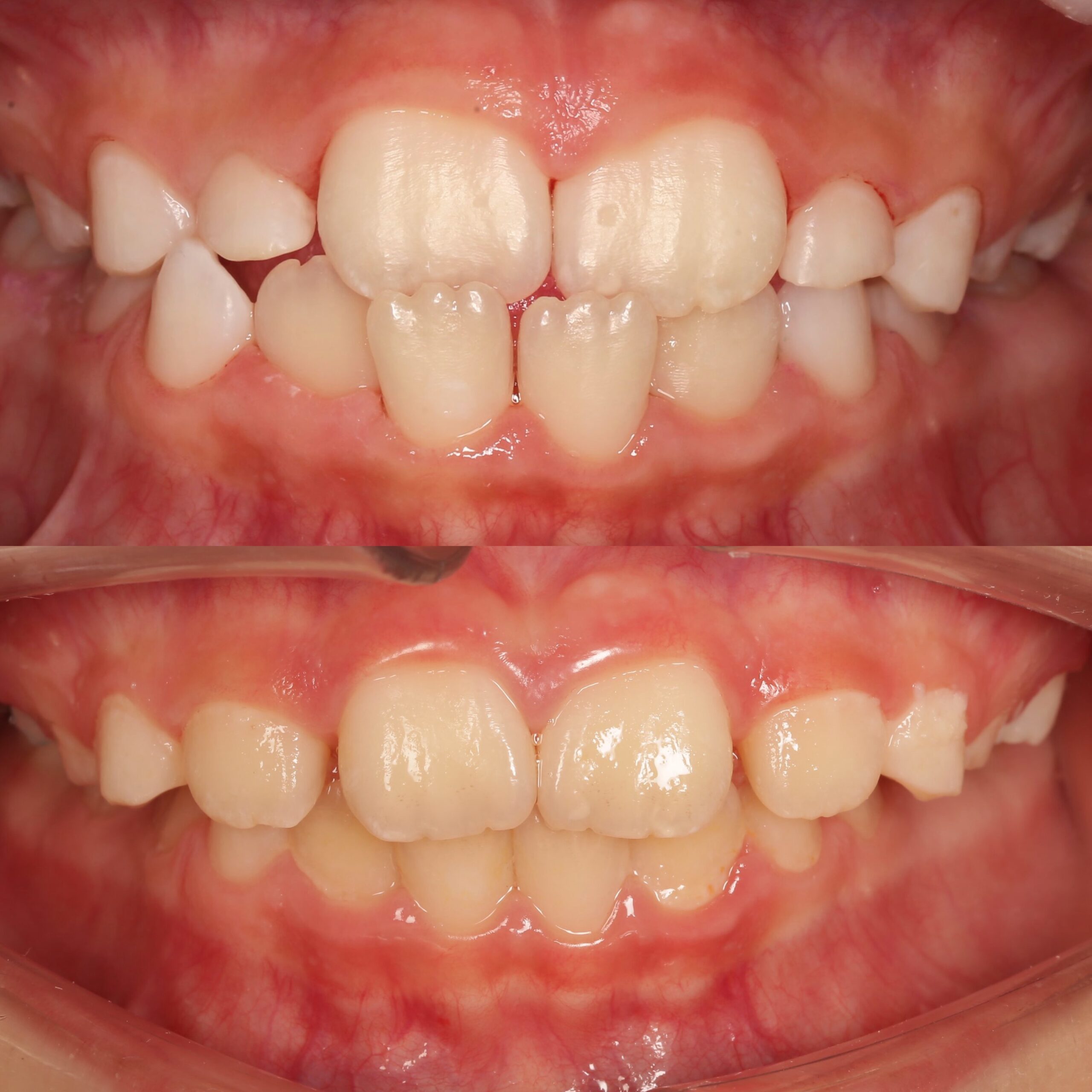 вирівнювання зубів