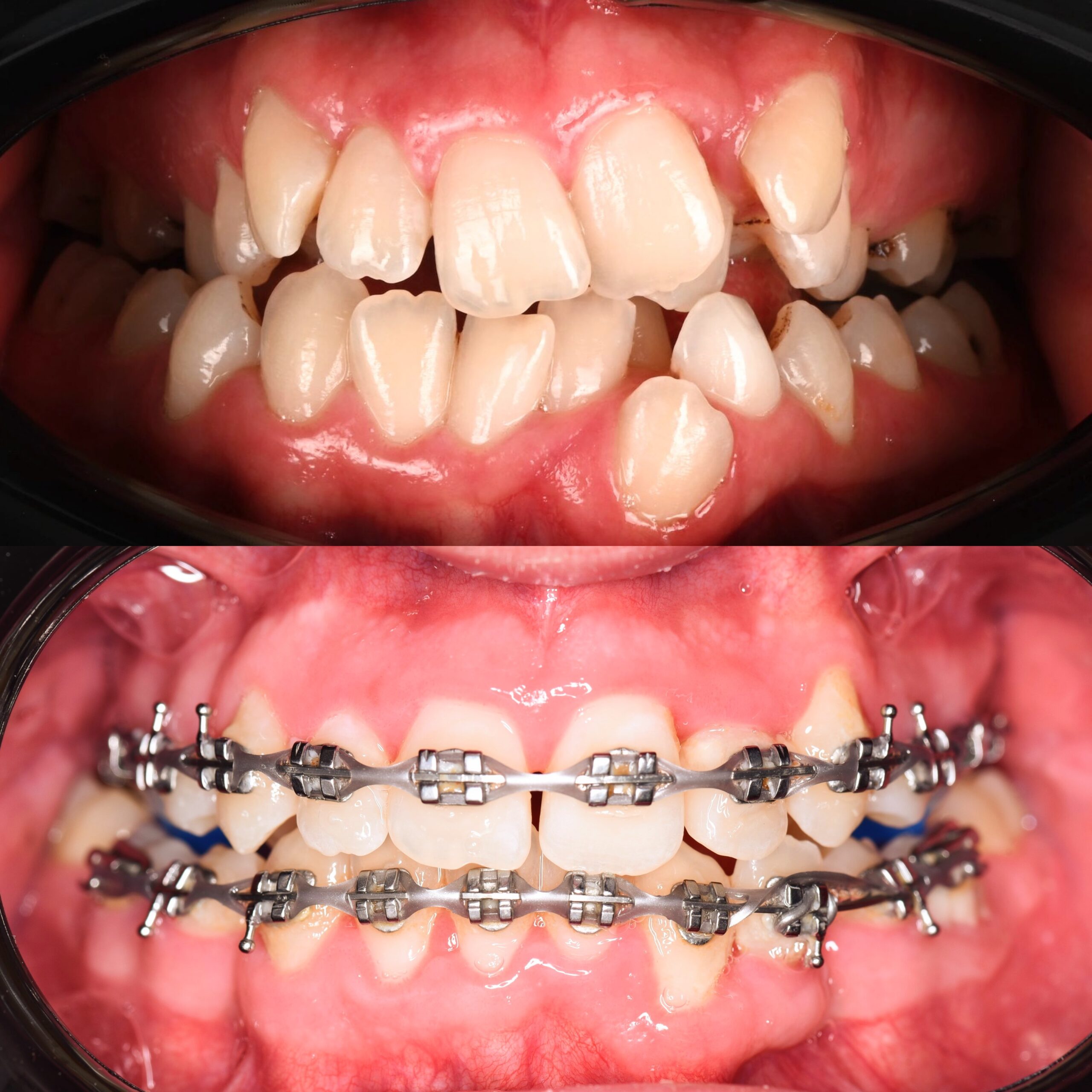 металеві брекети