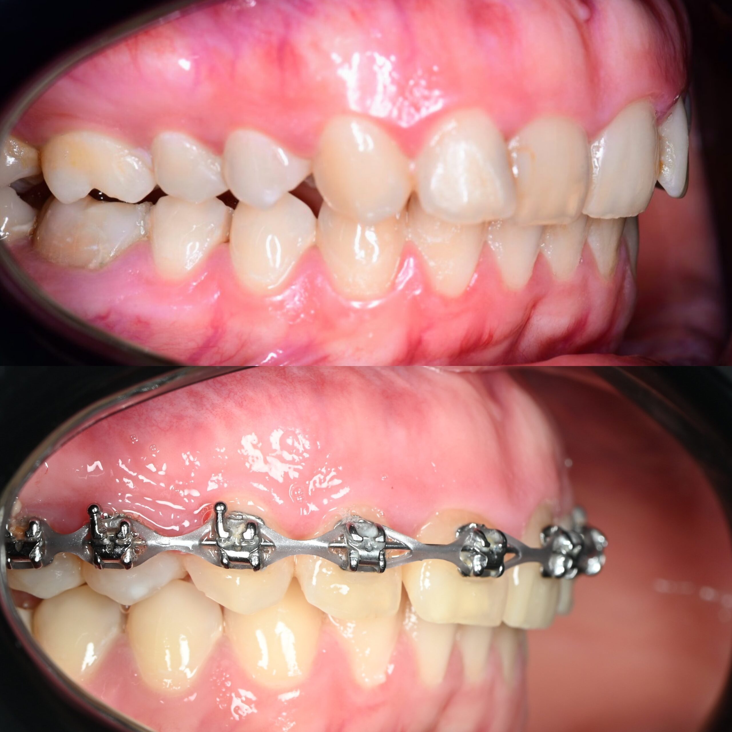 виправлення прикусу