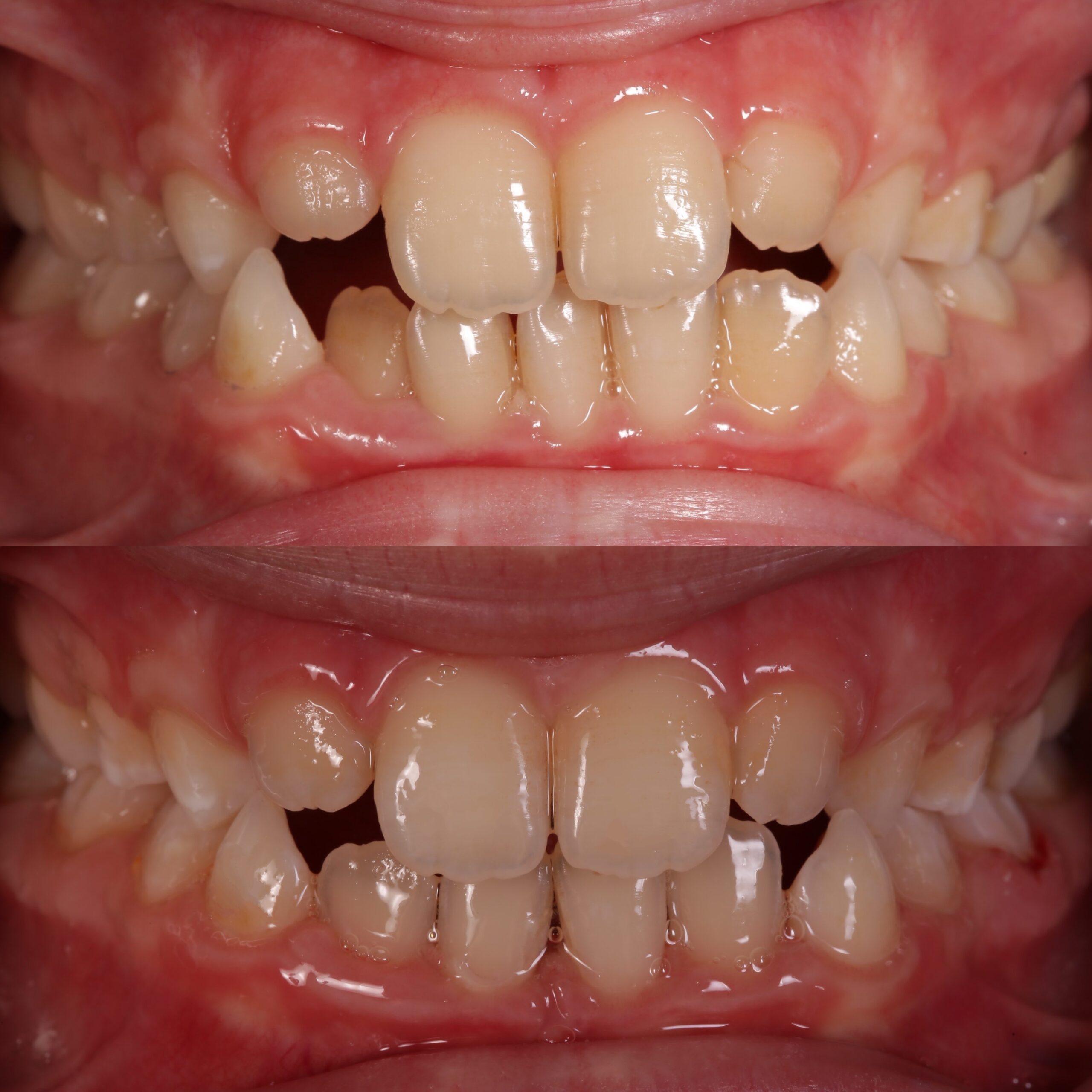 керамічні брекети