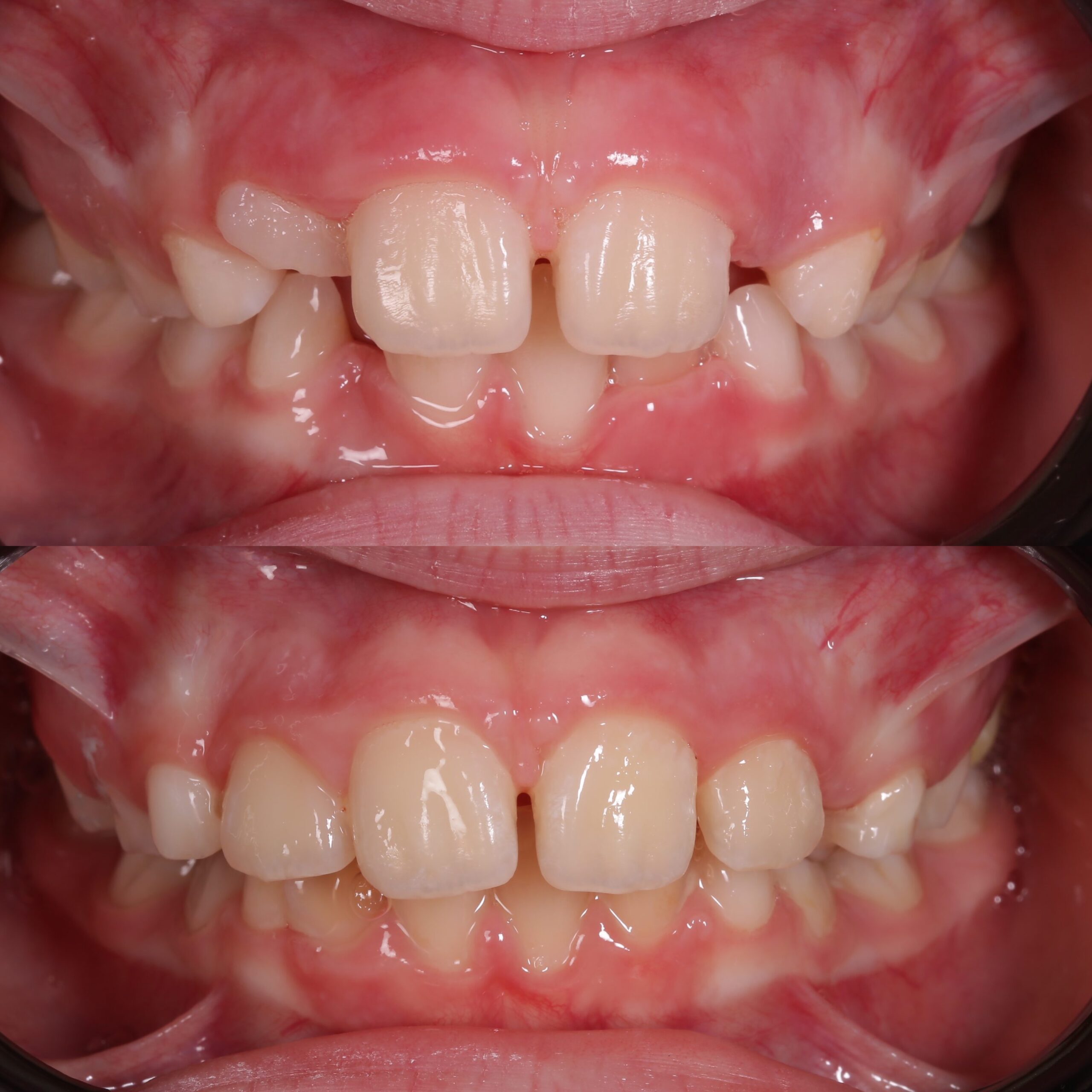 порушення прикусу