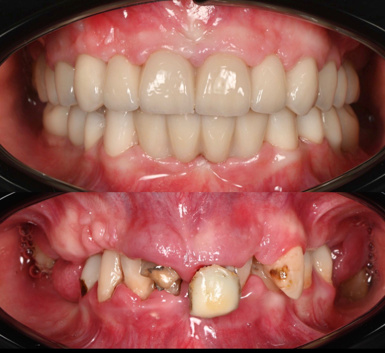 імплантація зубів