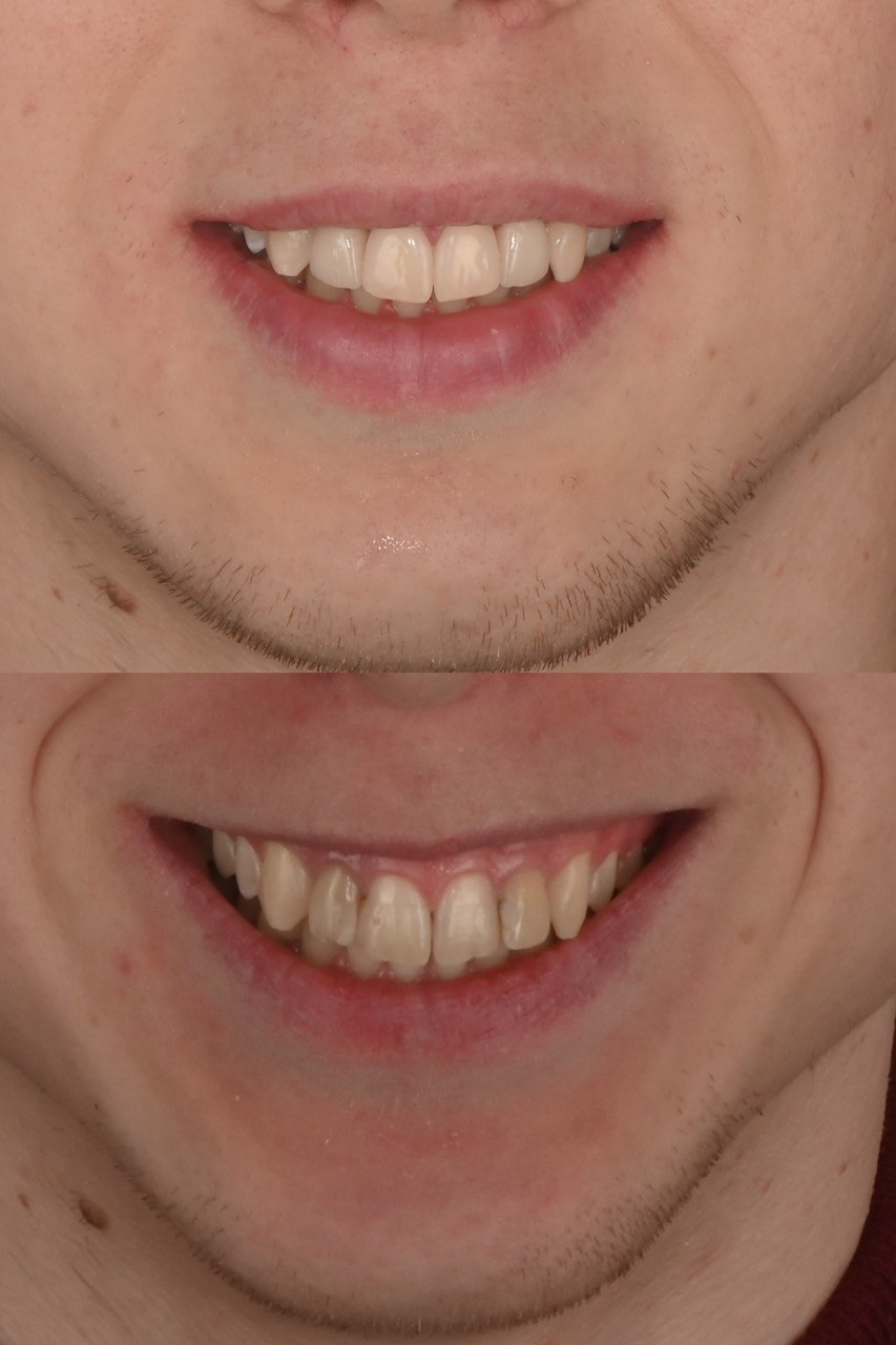 коронка цирконієва