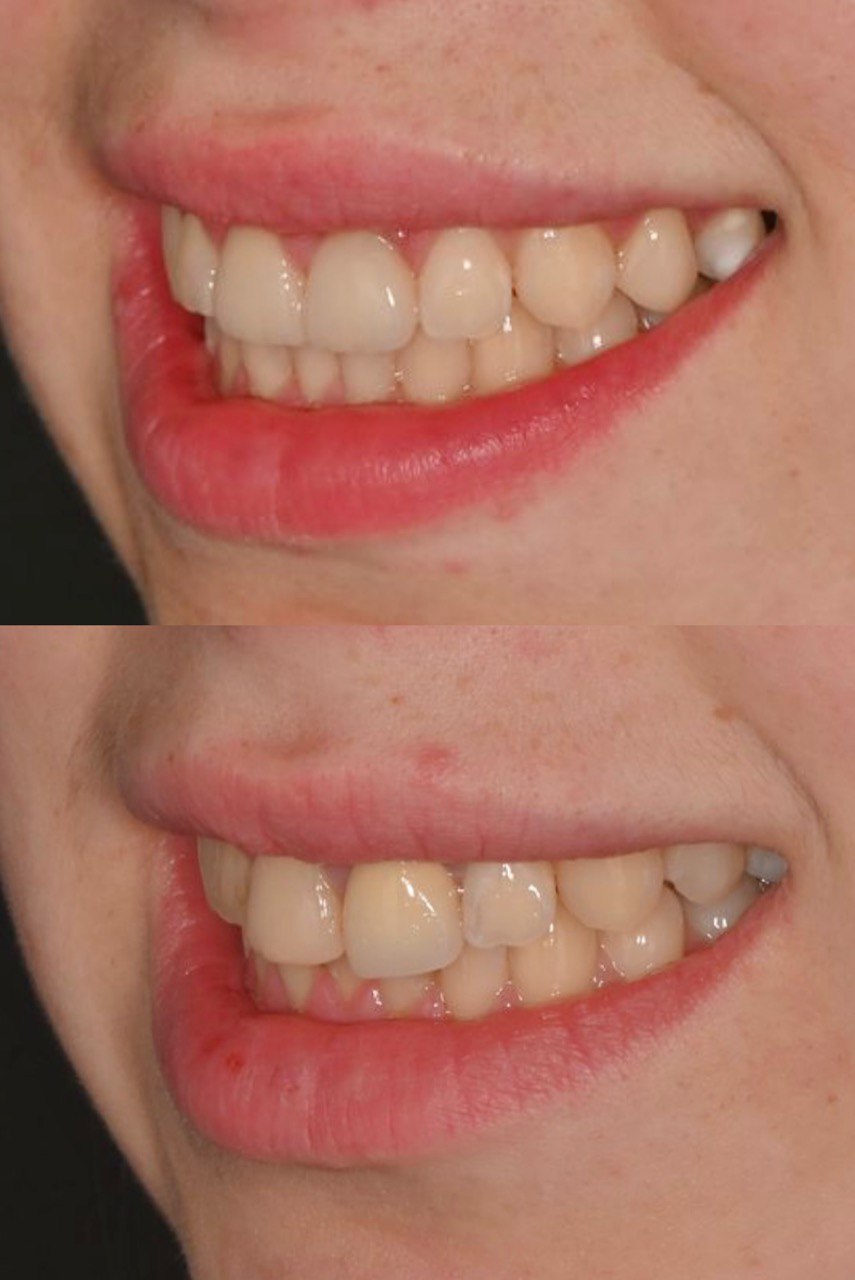 композитний вінір