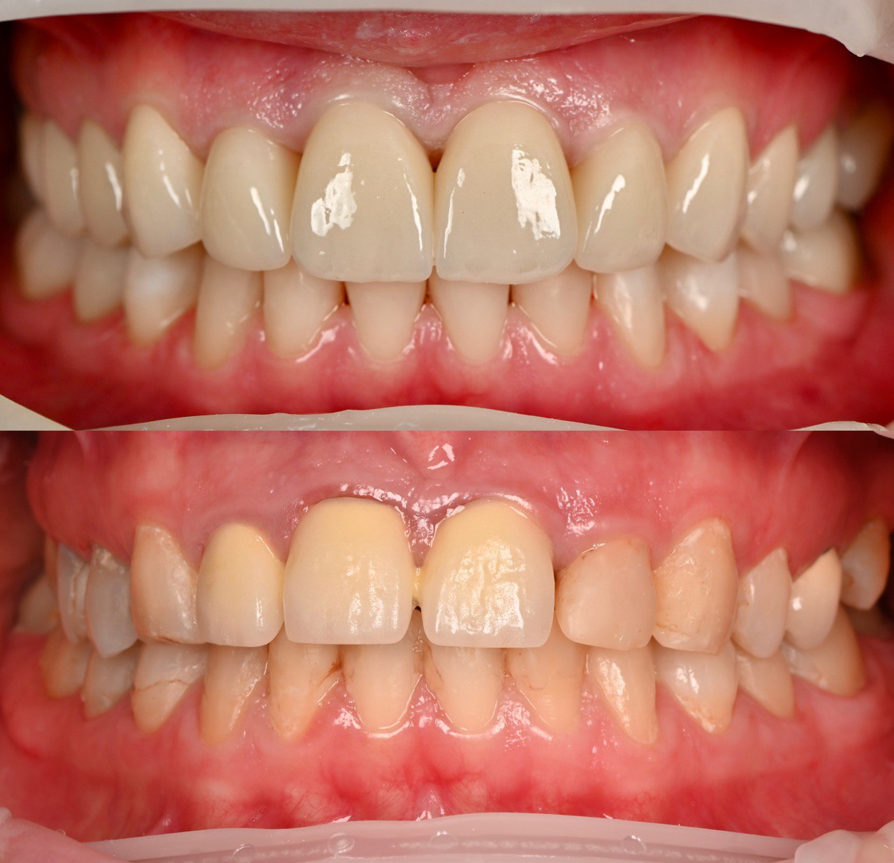 вінір керамічний