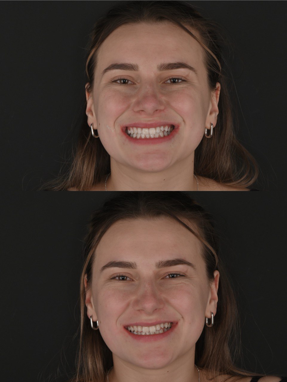 beyond відбілювання зубів