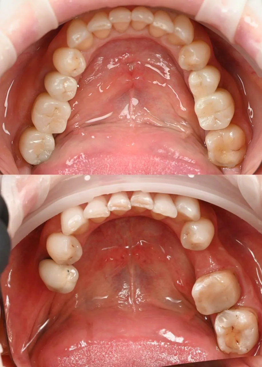 протезування