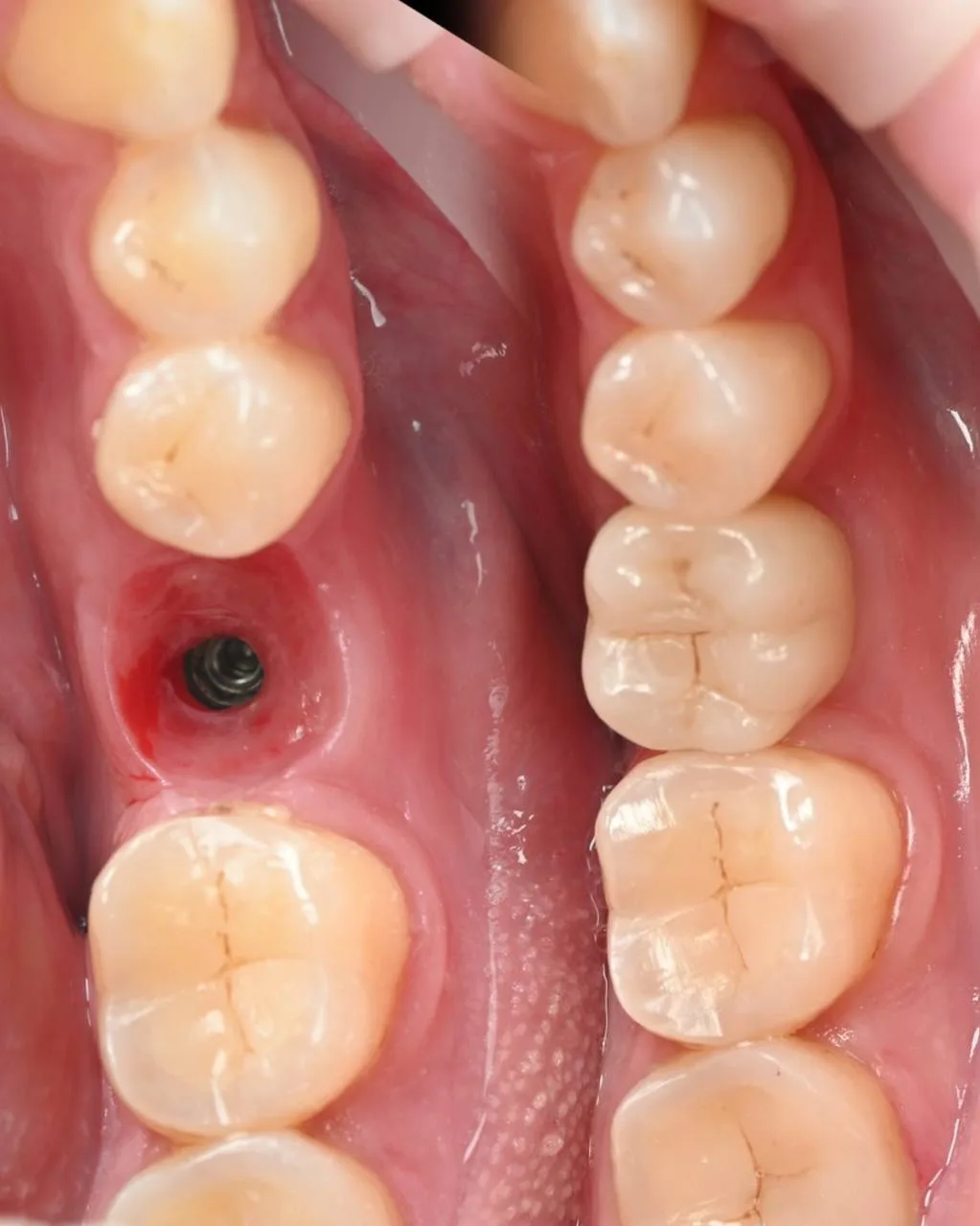 керамічний вінір