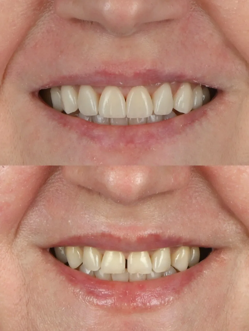 коронка цирконієва