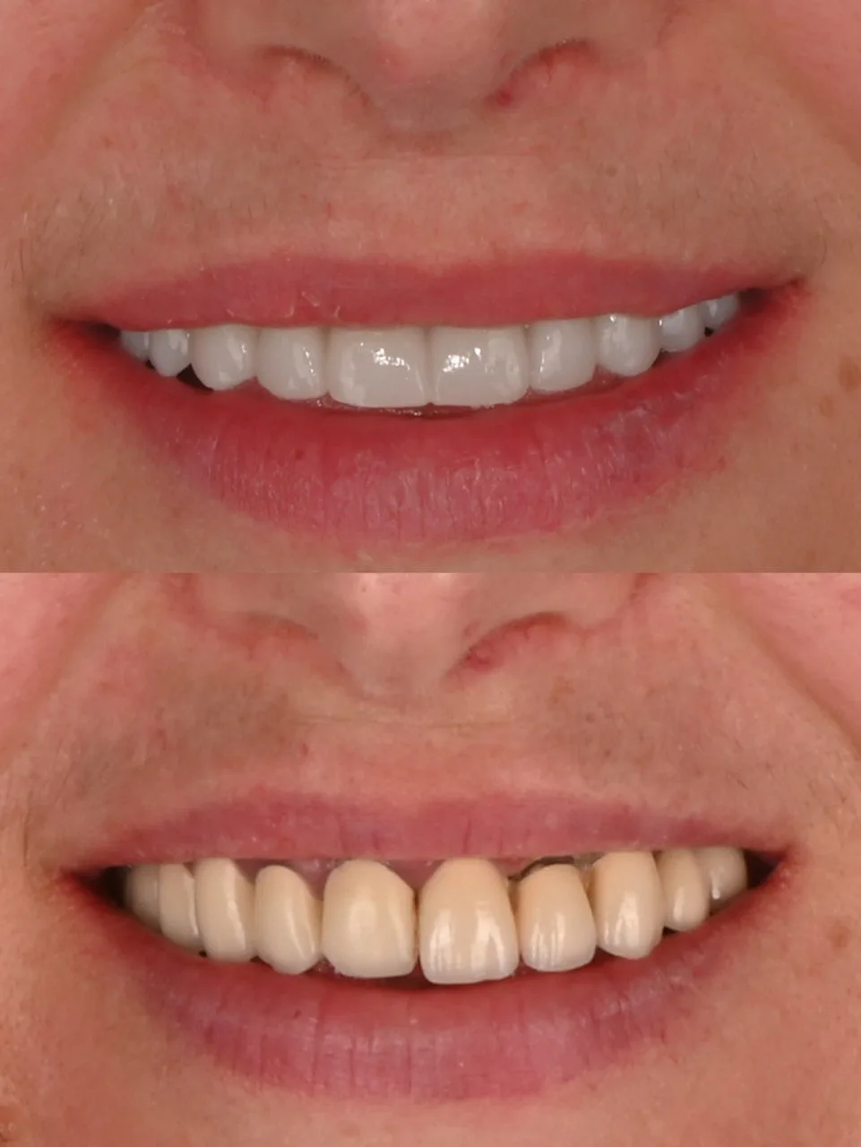 цирконієва коронка