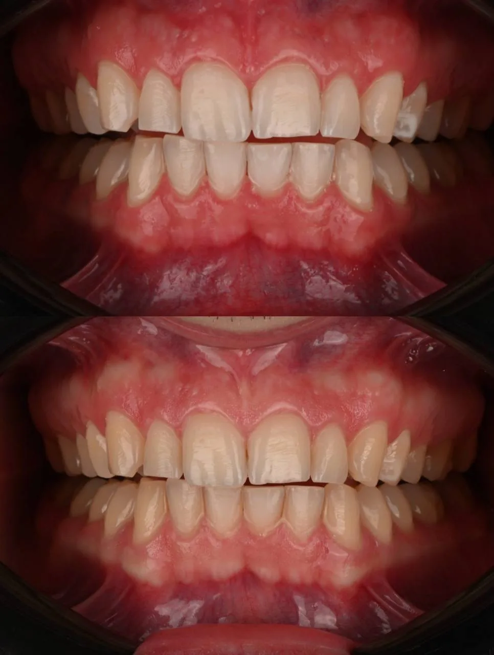 відбілити зуби