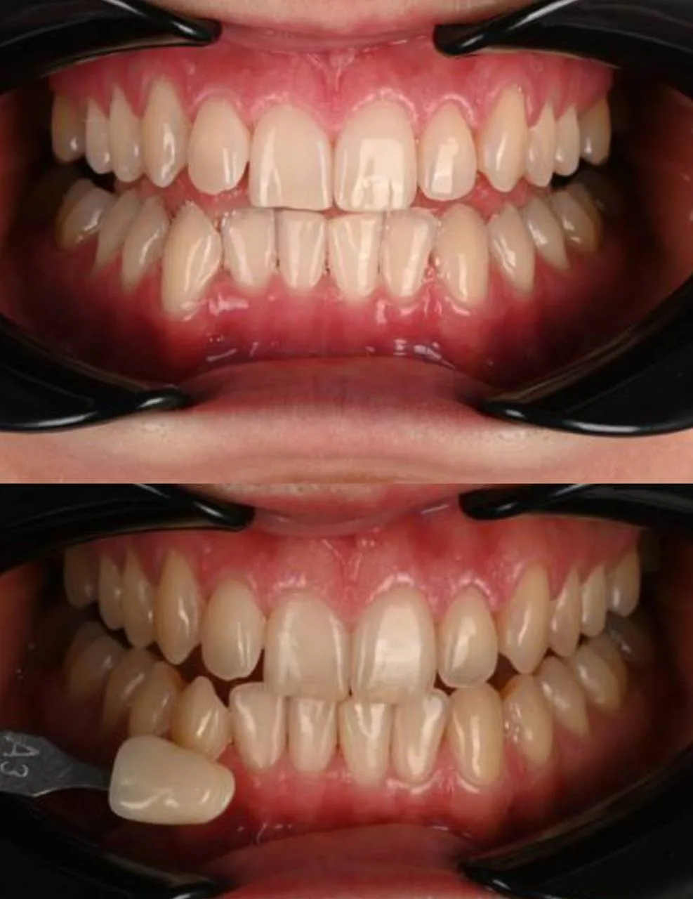 відбілювання зубів